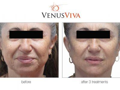 reduce wrinkles and deep lines on the face
