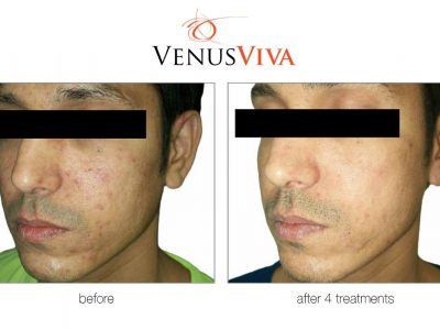 Improve skin repair after 4 treatments